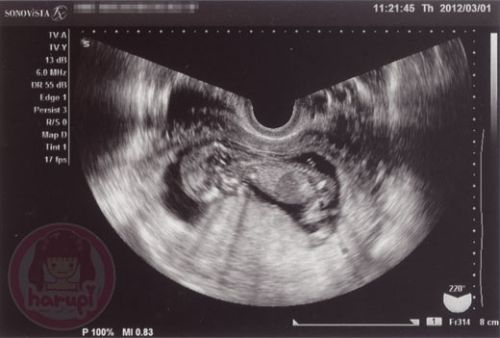 Prenatal check-up baby 12 weeks