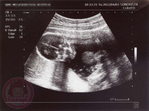 Prenatal check-up baby 17 weeks 1