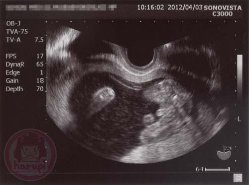 Prenatal check-up baby 17 weeks 2