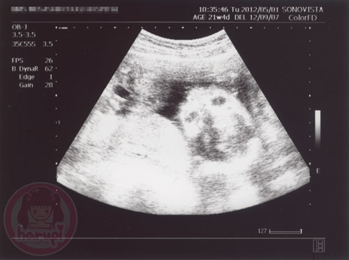 Prenatal check-up baby 21 weeks