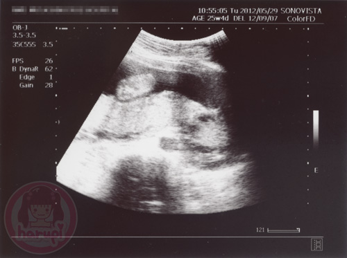 Prenatal check-up baby 25 weeks