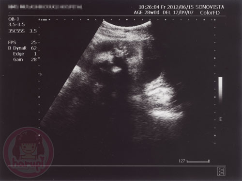 Prenatal check-up baby 28 weeks
