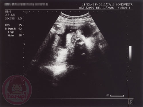 Prenatal check-up baby 32 weeks
