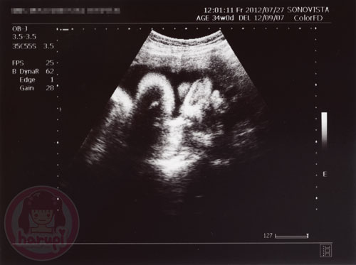 Prenatal check-up baby 34 weeks
