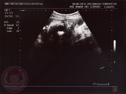 Prenatal check-up baby 36 weeks - 1