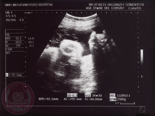 Prenatal check-up baby 37 weeks