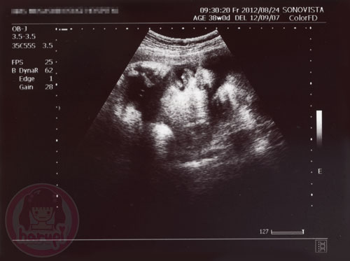 Prenatal check-up baby 38 weeks - 1