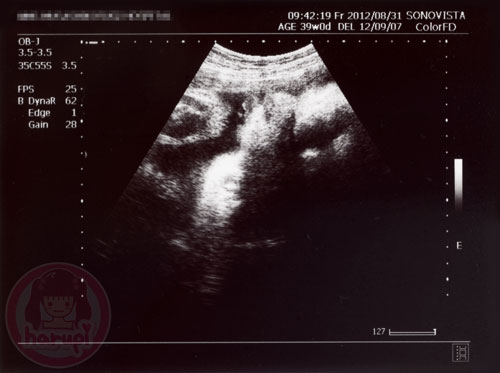 Prenatal check-up baby 39 weeks
